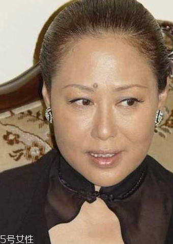 痣能摳掉嗎？這幾種痣摳掉會成瘤