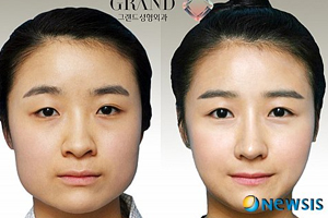 韓國人最愛整哪兒？韓國整形部位TOP4