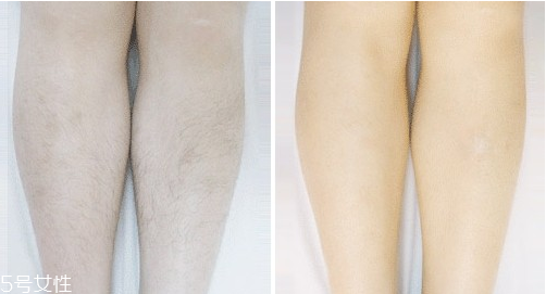 激光脫毛手術(shù)后怎么護(hù)理？激光脫毛一定要做好防曬