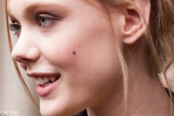 點(diǎn)痣的危害有哪些？激光點(diǎn)痣后的飲食禁忌