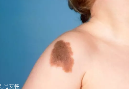痣什么情況下會(huì)轉(zhuǎn)變?yōu)榱?？點(diǎn)痣不可取