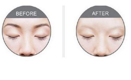 激光洗眉恢復期有疤痕怎么辦？激光洗眉毛之后正確護理方法