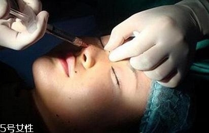 玻尿酸隆鼻多久能洗臉？玻尿酸隆鼻會越來越寬