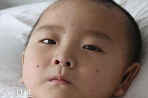 痣什么情況下會(huì)轉(zhuǎn)變?yōu)榱?？點(diǎn)痣不可取