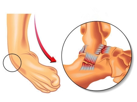 崴腳了怎么辦？緩解疼痛6大招