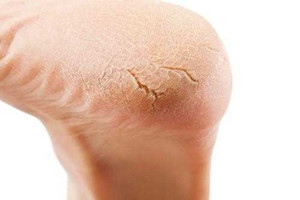 冬天裂腳怎么辦？5招緩解裂腳