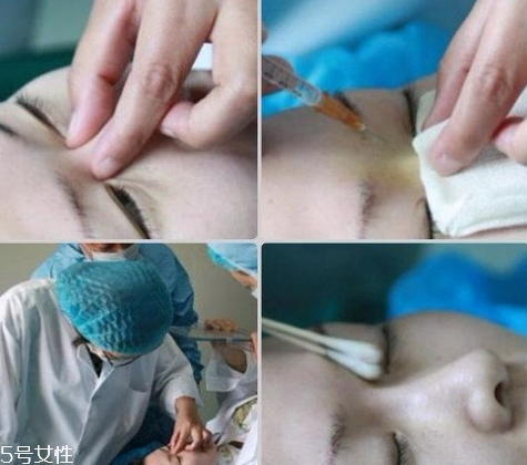 玻尿酸隆鼻維持時間受什么影響？玻尿酸不能過度注射