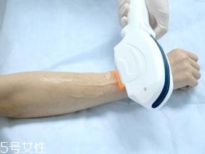 激光脫毛需要幾次？激光脫毛并不是終身有效的