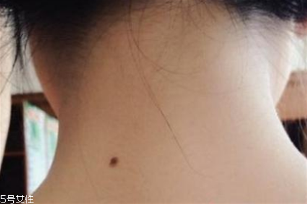 脖子后面有痣好嗎？激光冷凍祛痣易導(dǎo)致癌變
