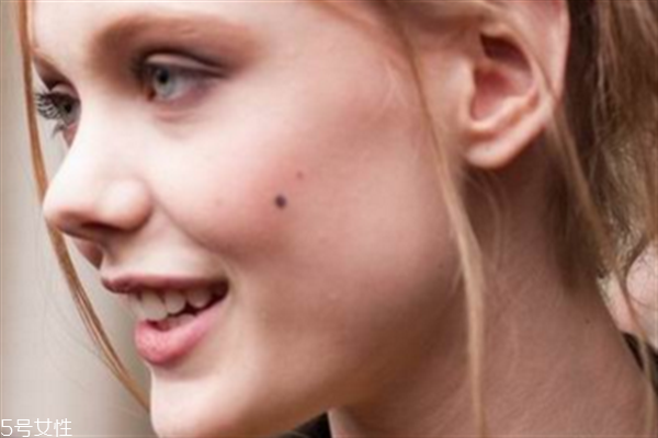 什么時(shí)候點(diǎn)痣最好？蘋果醋可以去痣