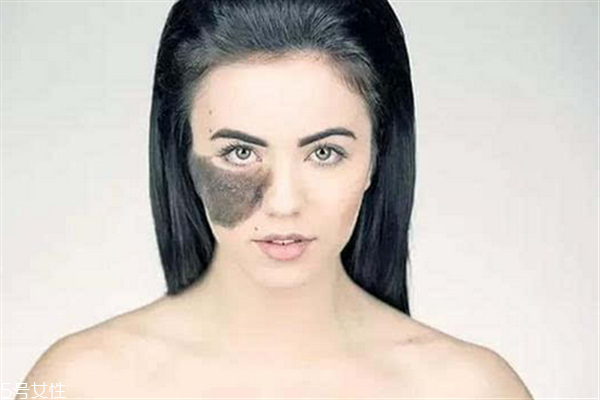 胎記長(zhǎng)在哪里有福氣？胎記的本質(zhì)是色素沉著