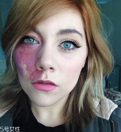 胎記長(zhǎng)在哪里有福氣？胎記的本質(zhì)是色素沉著