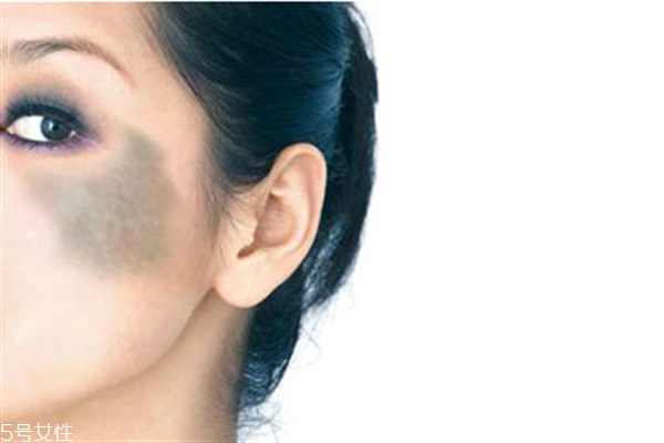 胎記怎么去除？胎記有遺傳的可能