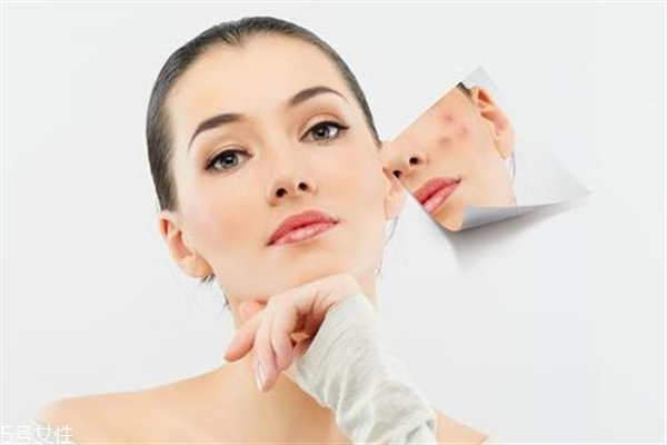 去胎記要多少錢？胎記去除后要做好護(hù)理