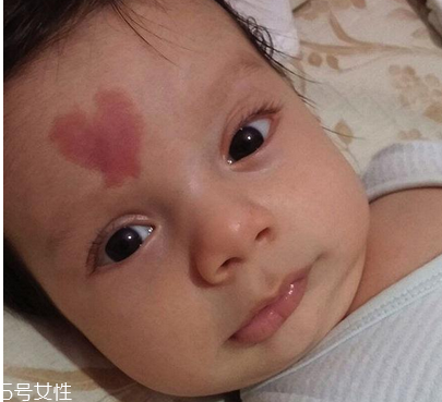 去胎記要多少錢(qián)？胎記去除后要做好護(hù)理