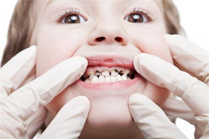 寶寶齲齒常有哪些問題？齲齒問題需注意