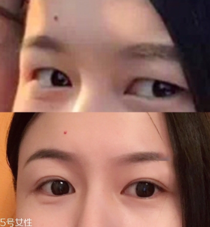 內(nèi)雙怎么進(jìn)化成雙眼皮？全是雙眼皮貼的功勞