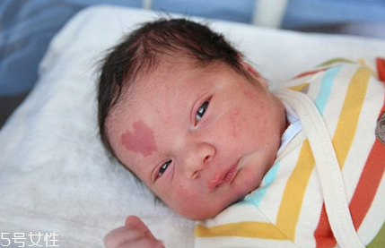 胎記長(zhǎng)在哪里有福氣？胎記的本質(zhì)是色素沉著