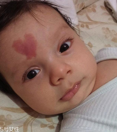 胎記長(zhǎng)在哪里有福氣？胎記的本質(zhì)是色素沉著