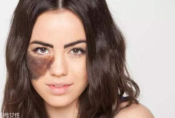 胎記長(zhǎng)在哪里有福氣？胎記的本質(zhì)是色素沉著