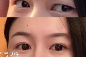 內(nèi)雙怎么進(jìn)化成雙眼皮？全是雙眼皮貼的功勞