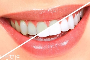 牙齒發(fā)黃是天生的嗎？只是你刷牙偷懶了