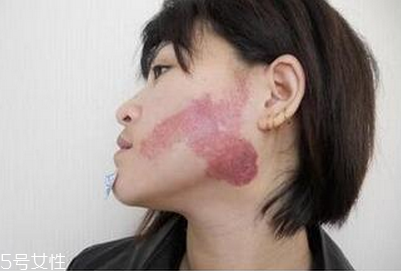 胎記怎么去除？胎記有遺傳的可能