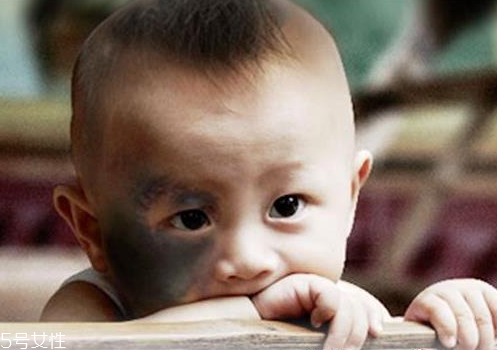 胎記怎么去除？胎記有遺傳的可能