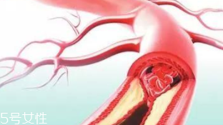 血管堵塞怎么自查？腿腳告訴你答案