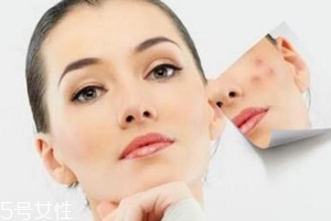 痘印多久能自行消失？多數(shù)人一年內(nèi)消失