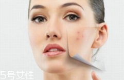 痘印多久能自行消失？多數(shù)人一年內(nèi)消失