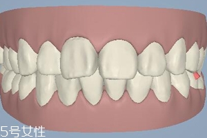 磨牙有哪些癥狀？牙齒變形甚至脫落