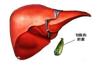 膽囊為什么容易長結(jié)石？與個體因素密切相關(guān)