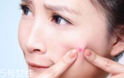 肌膚需要排毒嗎？長痘并不代表排毒