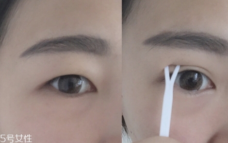 雙眼皮貼一般多少錢？