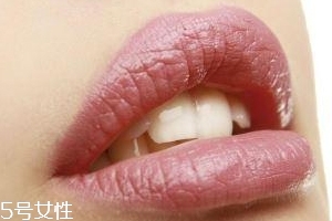 冬天爛嘴角什么原因？有可能營(yíng)養(yǎng)不良