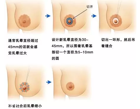 乳暈縮小術(shù)怎么做？乳暈縮小術(shù)知識全解