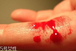 血友病的主要表現(xiàn)有哪些？出血是最明顯的特征