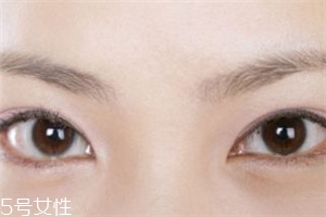 割雙眼皮后怎樣恢復快？女人不能割雙眼皮的時期