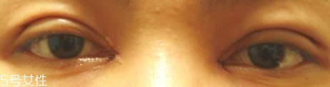 怎么縮短開眼角疤痕消失時間？雙眼皮開眼角恢復(fù)過程