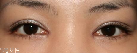 怎么縮短開眼角疤痕消失時間？雙眼皮開眼角恢復(fù)過程