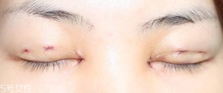 怎么縮短開眼角疤痕消失時間？雙眼皮開眼角恢復(fù)過程