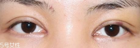 怎么縮短開眼角疤痕消失時間？雙眼皮開眼角恢復(fù)過程