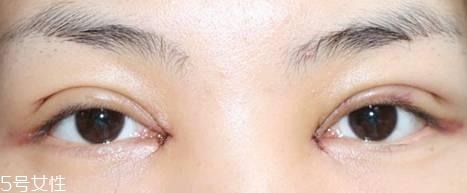 怎么縮短開眼角疤痕消失時間？雙眼皮開眼角恢復(fù)過程