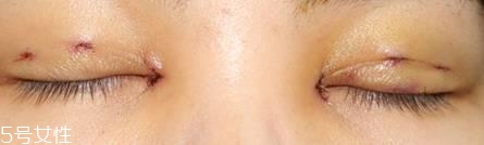 怎么縮短開眼角疤痕消失時間？雙眼皮開眼角恢復(fù)過程