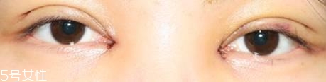 怎么縮短開眼角疤痕消失時間？雙眼皮開眼角恢復(fù)過程