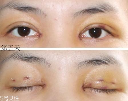 怎么縮短開眼角疤痕消失時間？雙眼皮開眼角恢復(fù)過程