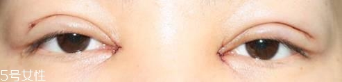 怎么縮短開眼角疤痕消失時間？雙眼皮開眼角恢復(fù)過程