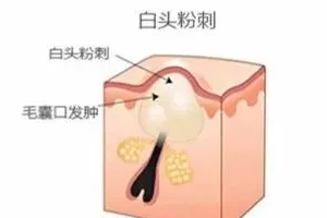 閉口是怎么引起的？4種情況要注意