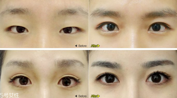 切開(kāi)雙眼皮效果好嗎？韓式雙眼皮和歐式雙眼皮區(qū)別